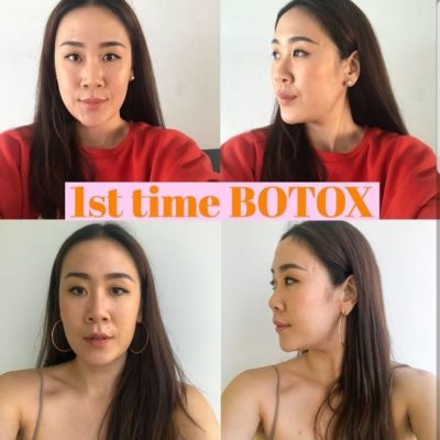botox v shaped face